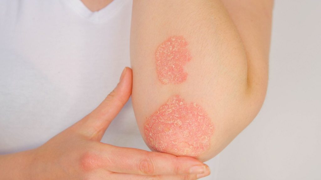 woman with elbow psoriasis