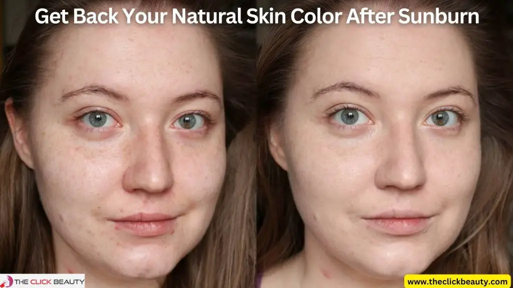 Get back your natural skin color after sunburn