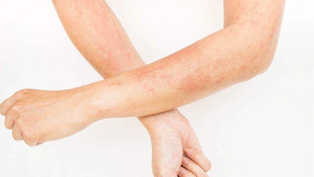 fungal-issue-on-forearms-1024x576-5709208